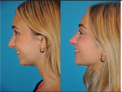 Dr. Barry Weintraub - Subtle Rhinoplasty